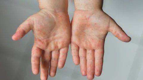 Viruela del mono: ¿a quiénes está afectando? Viruela del mono: aumentan los casos