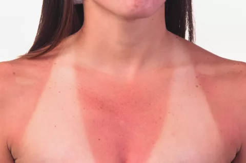 Verano: cómo cuidar la piel de las quemaduras del sol Quemaduras por el sol: ¿cómo podés protegerte para evitarlas?