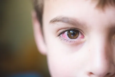 Cómo darte cuenta que tu hijo tiene conjuntivitis y cuánto dura el tratamiento Cómo darte cuenta que tu hijo tiene conjuntivitis y cuánto dura el tratamiento