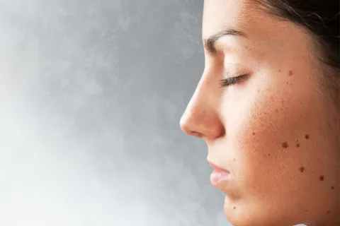 Día Mundial de los Lunares: esto es lo que tenés que observar de tus lunares para detectar lesiones sospechosas Cómo detectar un melanoma.