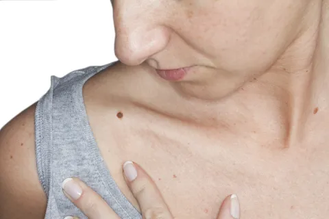 Cómo prevenir el melanoma, una de las formas más mortales de cáncer de piel Cáncer de piel: cómo prevenir el melanoma.