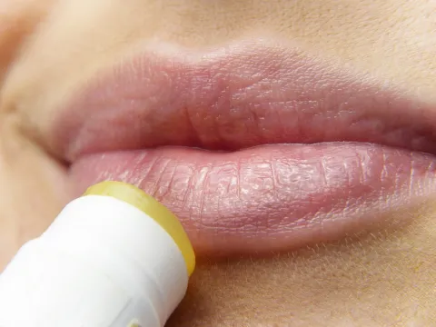 Herpes labial: causas, contagio y tratamiento Herpes labial: ¿por qué aparecen una y otra vez y cómo protegernos?