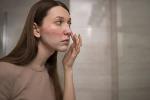 Rosácea: qué es y cómo prevenirla, según una experta Una mujer con rosacea