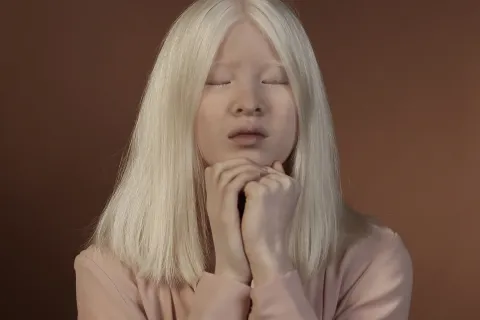 Día Internacional de Sensibilización sobre el Albinismo: concientizar para prevenir el bullying Xueli Abbing, la joven albina de China modelo de Vogue
