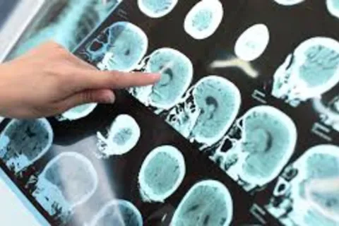 Día Mundial de la lucha contra la ELA: ¿Por qué se conmemora hoy su día? La esclerosis múltiple es una enfermedad del sistema nervioso central que, hasta el momento, no tiene cura