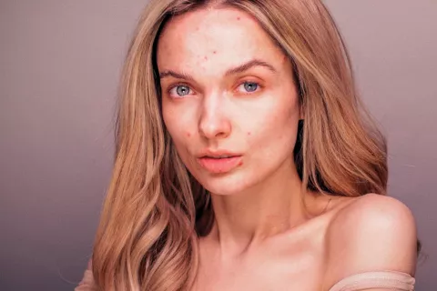 Skin positive: el movimiento que busca cuidar y mostrar la piel tal como es Em Ford es una bloguera de belleza y considerada la gran precursora del movimiento skin positive.
