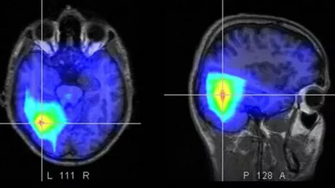Salud: cómo reconocer un ACV y qué hacer inmediatamente M43FMPKWS5HDRGXAQCCF6UKJBA.jpg