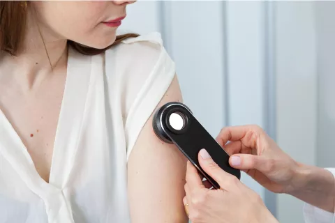 Día Mundial del Melanoma: chequear tus lunares es fundamental para prevenir el cáncer de piel WU5F4SWBSJF7HNTC2Z5KQTF62E.jpg