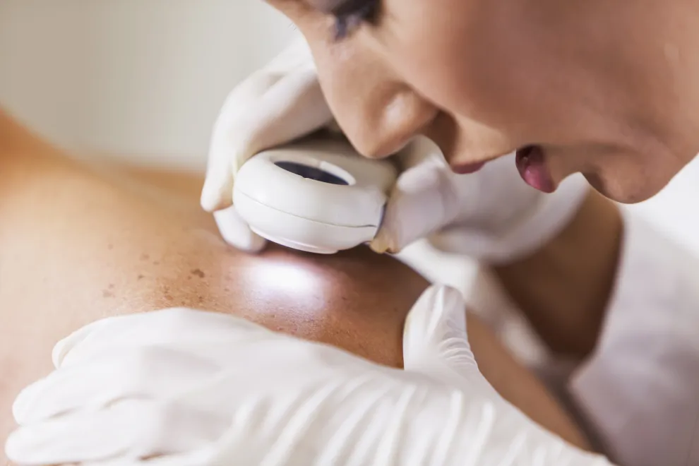 revisión de los lunares para prevenir cáncer de piel
