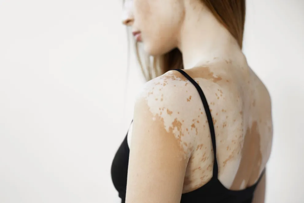 Qué es el Vitiligo y por qué sale: la mirada de una experta