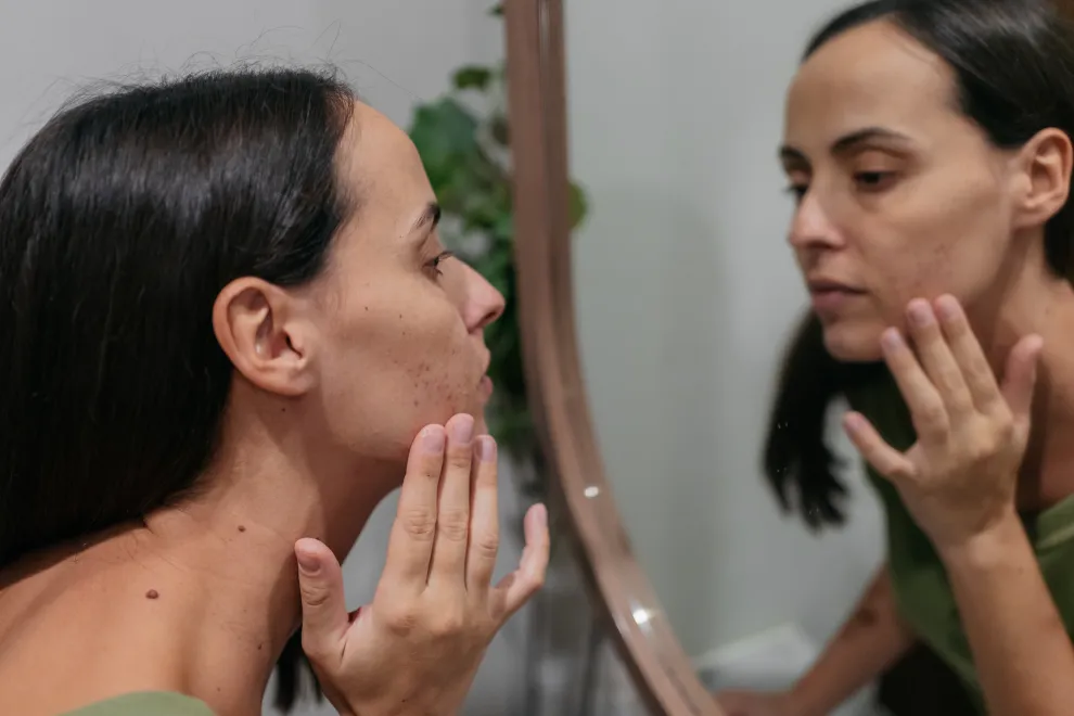 Acné en verano: por qué el sol puede empeorarlo y cómo tratarlo, según una experta